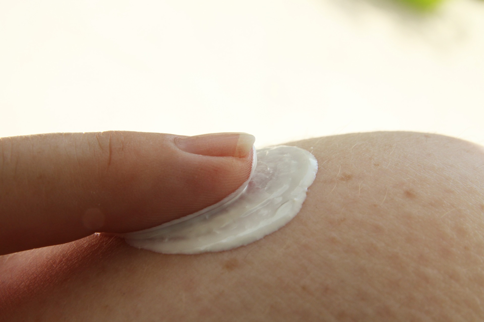 Weiblicher Zeigefinger verteilt Creme auf einer Neurodermitis geplagten Haut mit Ausschlag.
